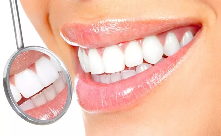 Zęby wybielone metodą nakładkową