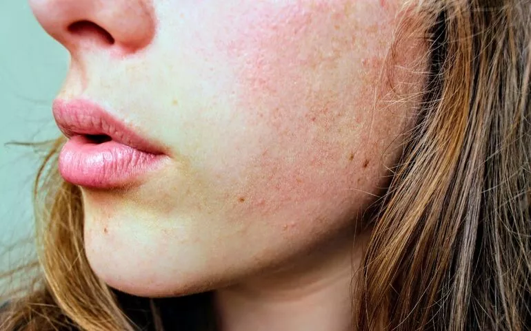 Jedną z najczęstszych przyczyn zaczerwienionej skóry twarzy jest nieodpowiedni krem.