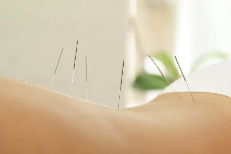 Czy akupunktura pomaga? Kiedy warto ją zastosować?
